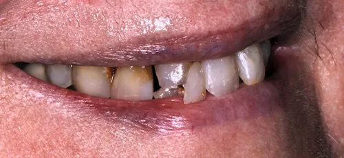 Close up of a smile with severely stained and damaged teeth