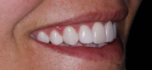 Smile with whiter and evenly aligned teeth