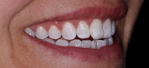 Smile with slightly uneven and discolored teeth