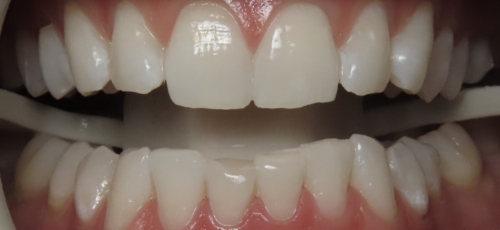 Close up of a mouth after whitening the teeth