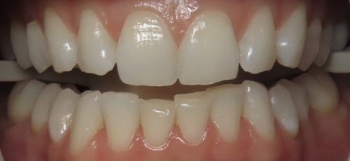 Close up of a mouth with slightly discolored teeth