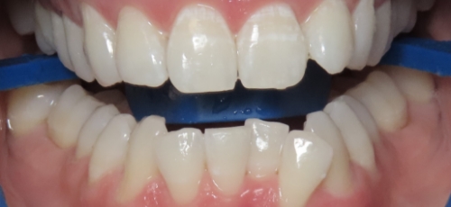Close up of a mouth after teeth whitening treatment