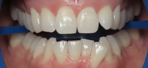 Close up of a mouth with slightly darkened teeth