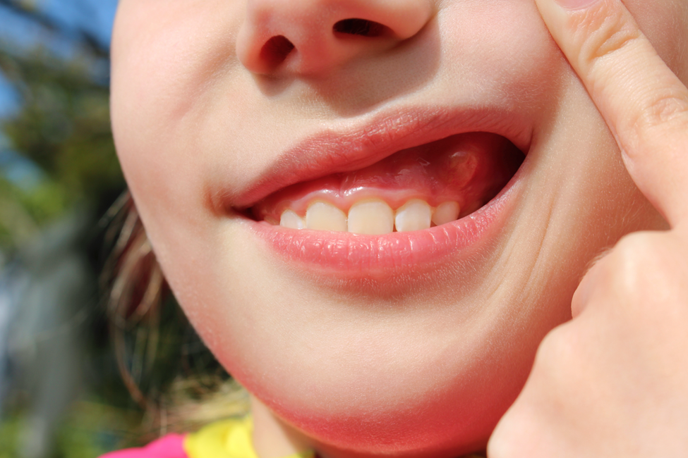 woman with bump on her gums